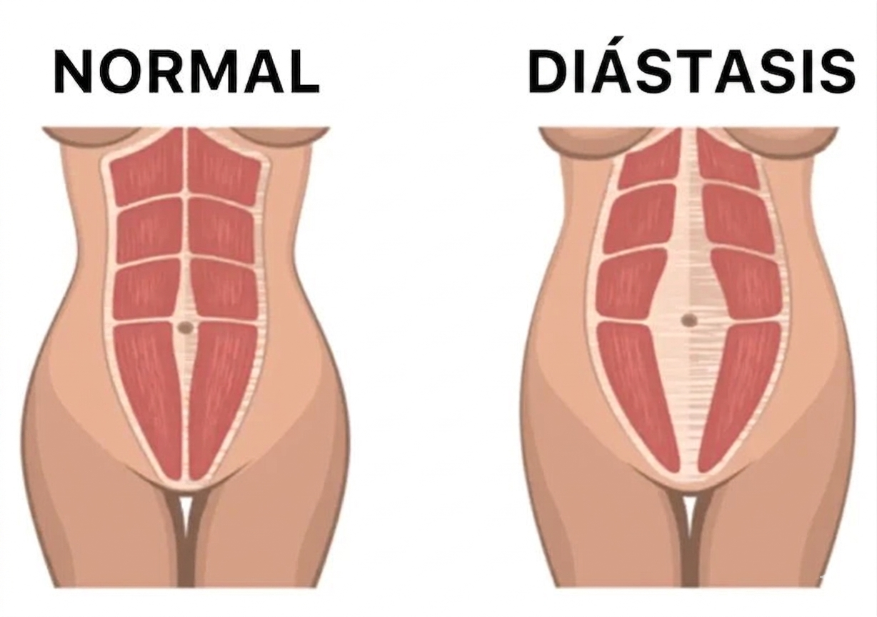 Diástasis